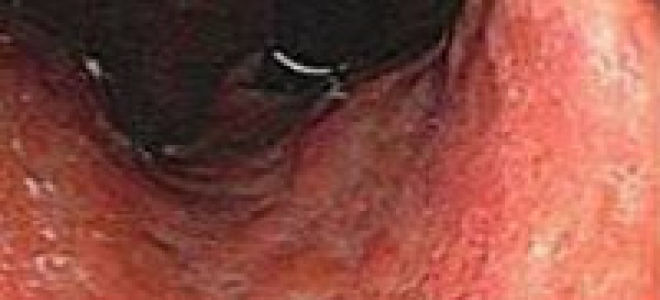 Обострение гастродуоденита: симптомы и лечение