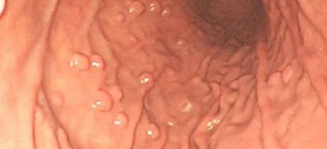 Гиперпластический и гиперплазиогенный полип желудка, симптомы и лечение