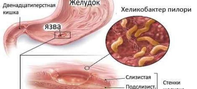 Как определить и вылечить гастрит, проверить в домашних условиях