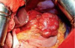 Гастроинтестинальная стромальная опухоль желудка (gist): причины, симптомы, лечение