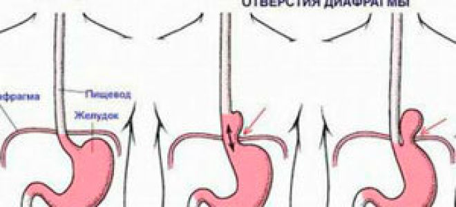 Боли в левом подреберье после еды: причины и лечение