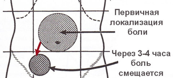 От чего появляется аппендицит: причины и симптомы