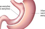 Продольная резекция желудка при ожирении — лапароскопическая, отзывы