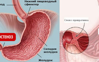 Стеноз привратника желудка — симптомы и лечение, что это такое