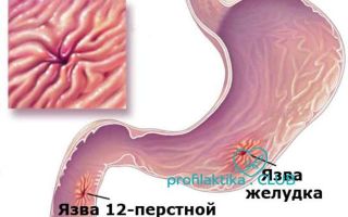 Профилактика язвенной болезни желудка и двенадцатиперстной кишки — лекарства