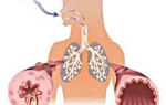 Бронхиальная астма: основные причины, методы терапии