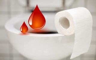 Кровь из попы: причины и лечение