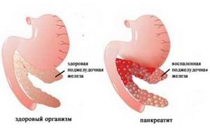 cимптомы заболевания поджелудочной железы у женщин и мужчин