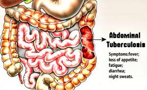 Туберкулез желудка: симптомы и лечение