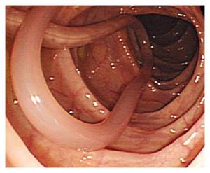 Глисты в желудке: симптомы, диагностика, лечение червей