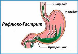 Причины гастрита желудка, основные факторы возникновения гастрита