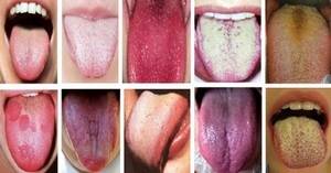 Желтый налет на языке: причины, диагностика и лечение у взрослых