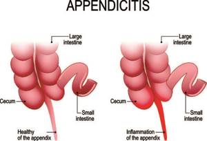Симптомы аппендицита у взрослых - причины, диагностика и признаки приступа