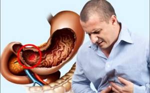 Язва антрального отдела желудка: отличительные особенности и методы лечения