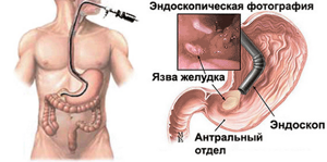Дисплазия желудка 1 степени - лечение, диагностика, причины