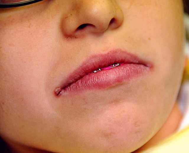 Заеды на губах: причины, как и чем лечить