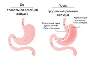 Рукавная резекция желудка как эффективный метод похудения