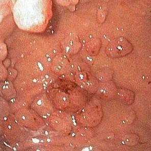 Лимфофолликулярная гиперплазия слизистой желудка: симптомы и лечение