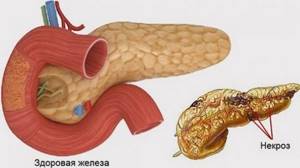 Что такое панкреонекроз: причины и лечение некротического панкреатита