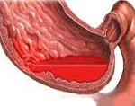 Симптомы желудочного кровотечения, признаки внутреннего кровоизлияния