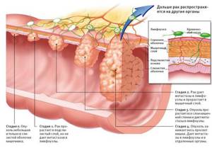 Болезни толстой кишки: симптомы и лечение заболеваний кишечника