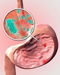 Чем лечить хеликобактерную инфекцию в желудке: доступные и эффективные методы