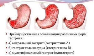 Виды гастрита желудка, какие бывают разновидности, лечение