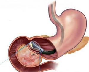 Гистология желудка - когда показана и как подготовиться к процедуре