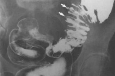 Рентген кишечника с барием - что показывает исследование