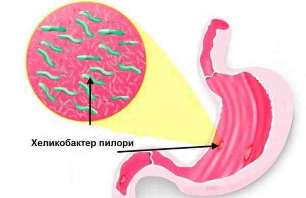 Гиперплазия слизистой желудка - что это, лечение