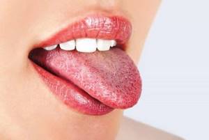 Причины появления белого налета на языке,  методы лечения