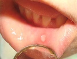 Сладкий привкус во рту: причины у женщин и мужчин и лечение сладкой слюны
