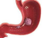 Гастроинтестинальная стромальная опухоль желудка (gist): причины, симптомы, лечение