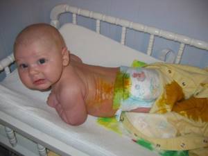 Понос у грудного ребенка 8 месяцев, лечение и первая помощь