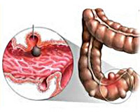 Дивертикулез толстого кишечника: симптомы и лечение, дивертикулярная болезнь
