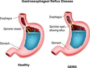 Гастроэзофагеальный рефлюкс: симптомы и лечение гэр желудка