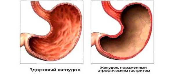 Атрофия слизистой оболочки желудка: симптомы, диагностика и лечение