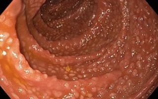 Гиперплазия слизистой оболочки желудка и ее формы