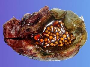 Камни в желудке: виды, причины, симптомы, диагностика и лечение