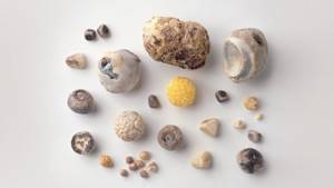 Причины появления камней в желчном пузыре