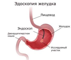 Эндоскопия желудка что это такое? Подготовка, эндоскопическое исследование желудка