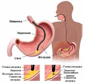Гистология желудка - когда показана и как подготовиться к процедуре