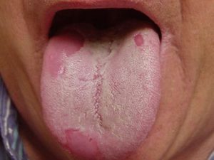 Желтый налет на языке: причины, диагностика и лечение у взрослых