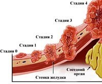 Карцинома желудка симптомы, причины и лечение