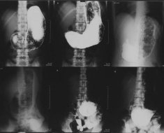 Рентген желудка с барием что показывает, последствия
