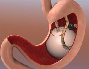 Шунтирование желудка – отзывы и что это такое?