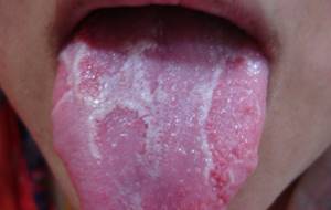 Почему белый налет на языке: причины, лечение, симптомы, язвы у подростка