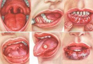 Почему белый налет на языке: причины, лечение, симптомы, язвы у подростка