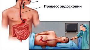 Подготовка к процедуре эндоскопического исследования желудка