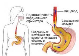 Стеноз желудка и двенадцатиперстной кишки: причины и лечение